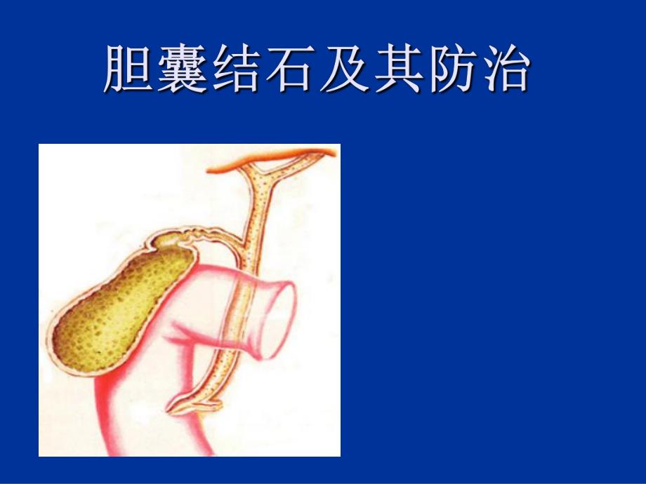 胆囊结石及防治.ppt_第1页