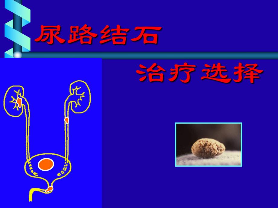 尿路结石治疗选择.ppt_第1页