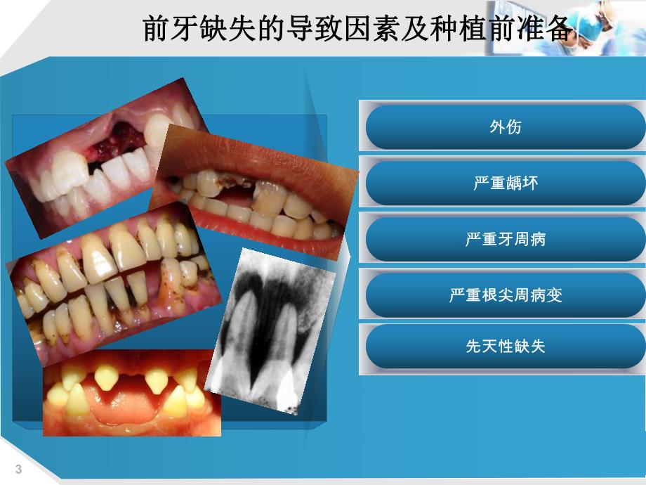 种植手术中的基本 外科原则.ppt_第3页