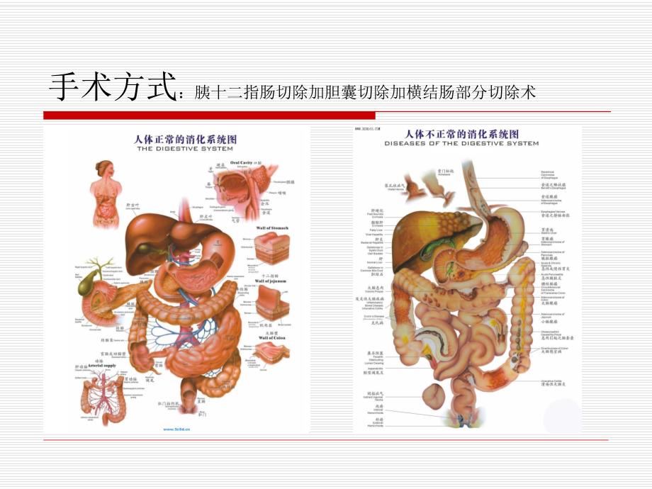 胰十二指肠切除加胆囊切除加横结肠部分切除术后患者的护理查房.ppt_第3页