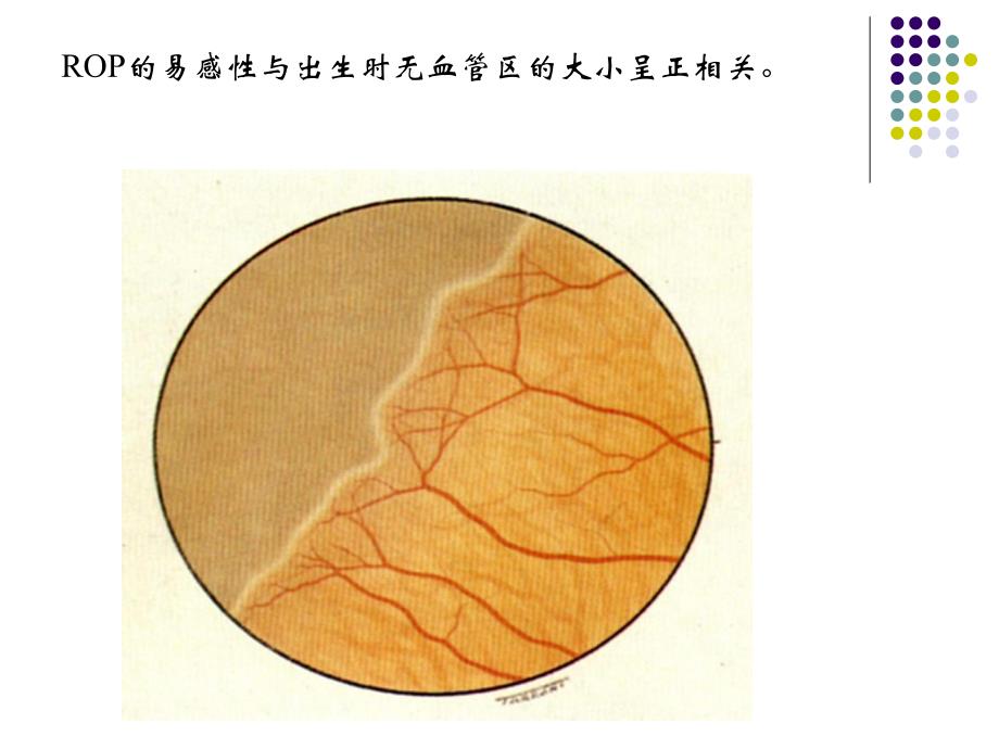 早产儿视网膜病.ppt_第3页