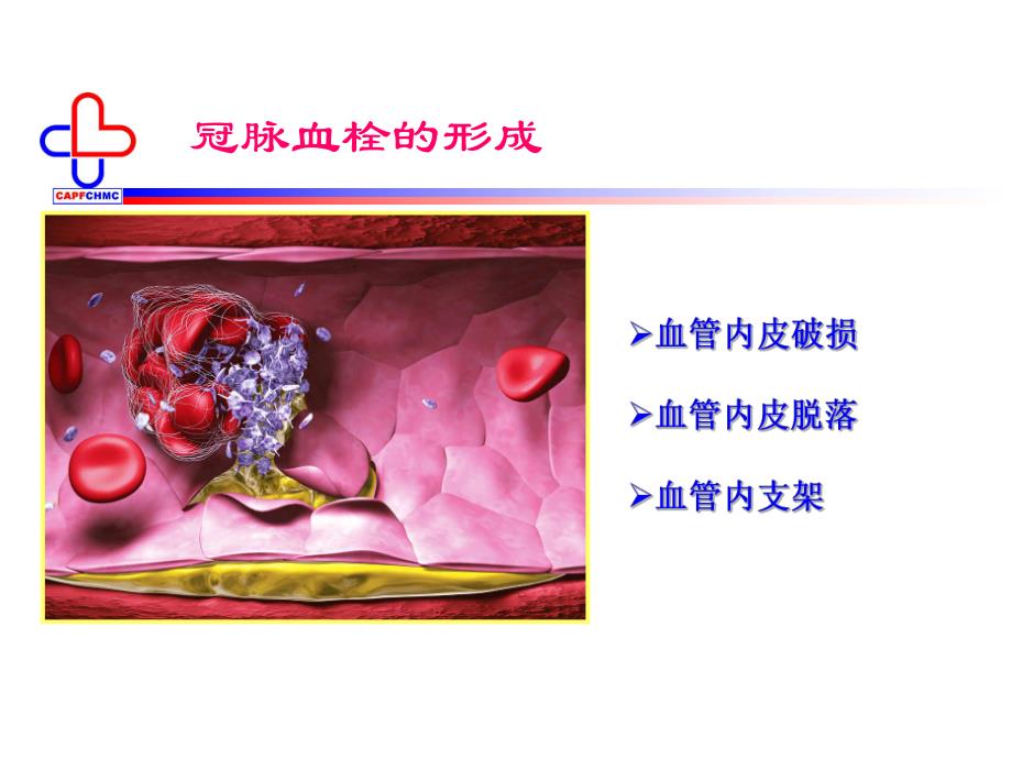 抗血小板药物的应用.ppt_第3页