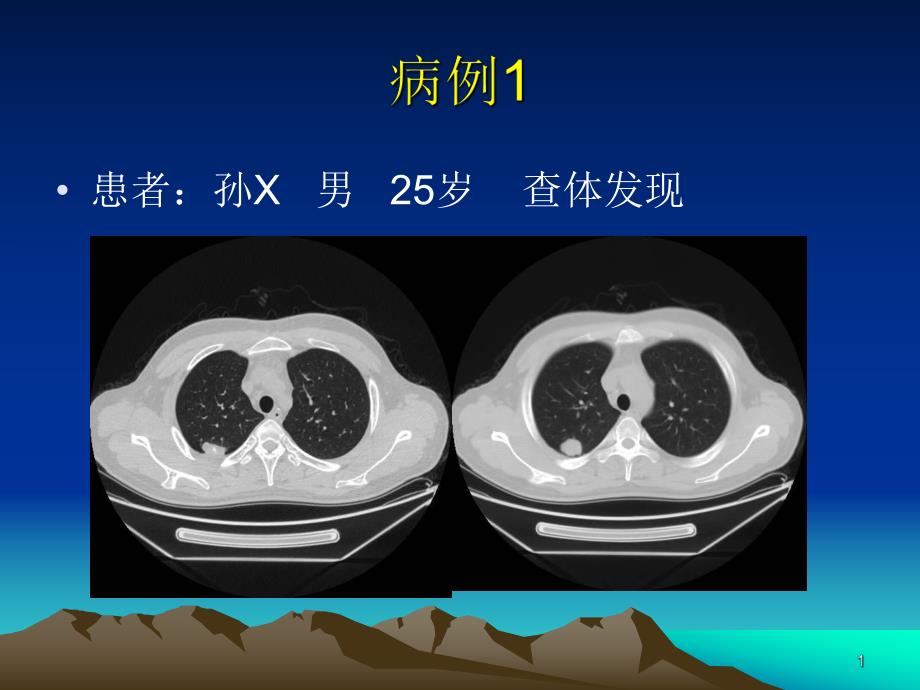 医学ppt肺错构瘤影像表现.ppt_第1页