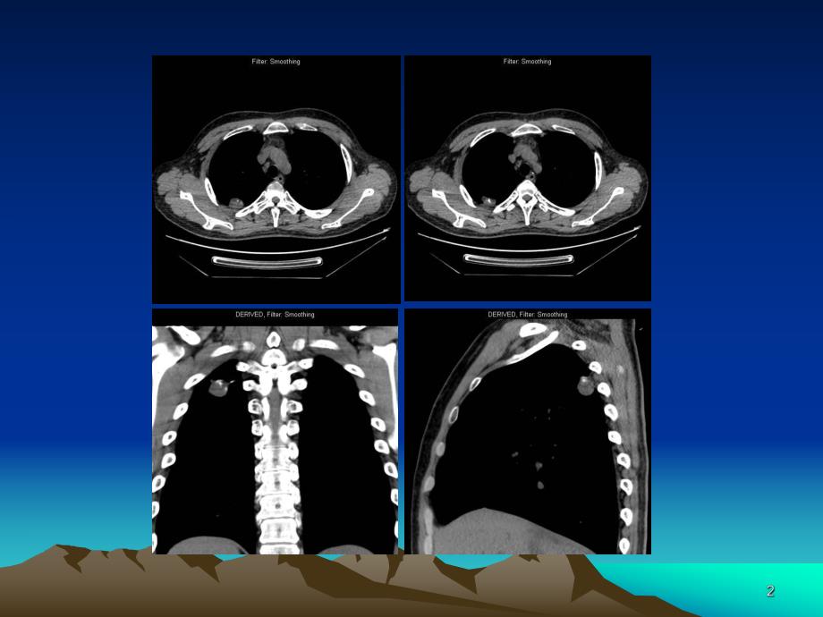 医学ppt肺错构瘤影像表现.ppt_第2页