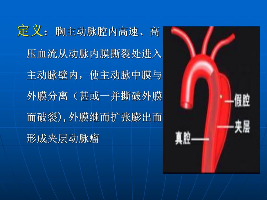 主动脉夹层.ppt.ppt_第3页