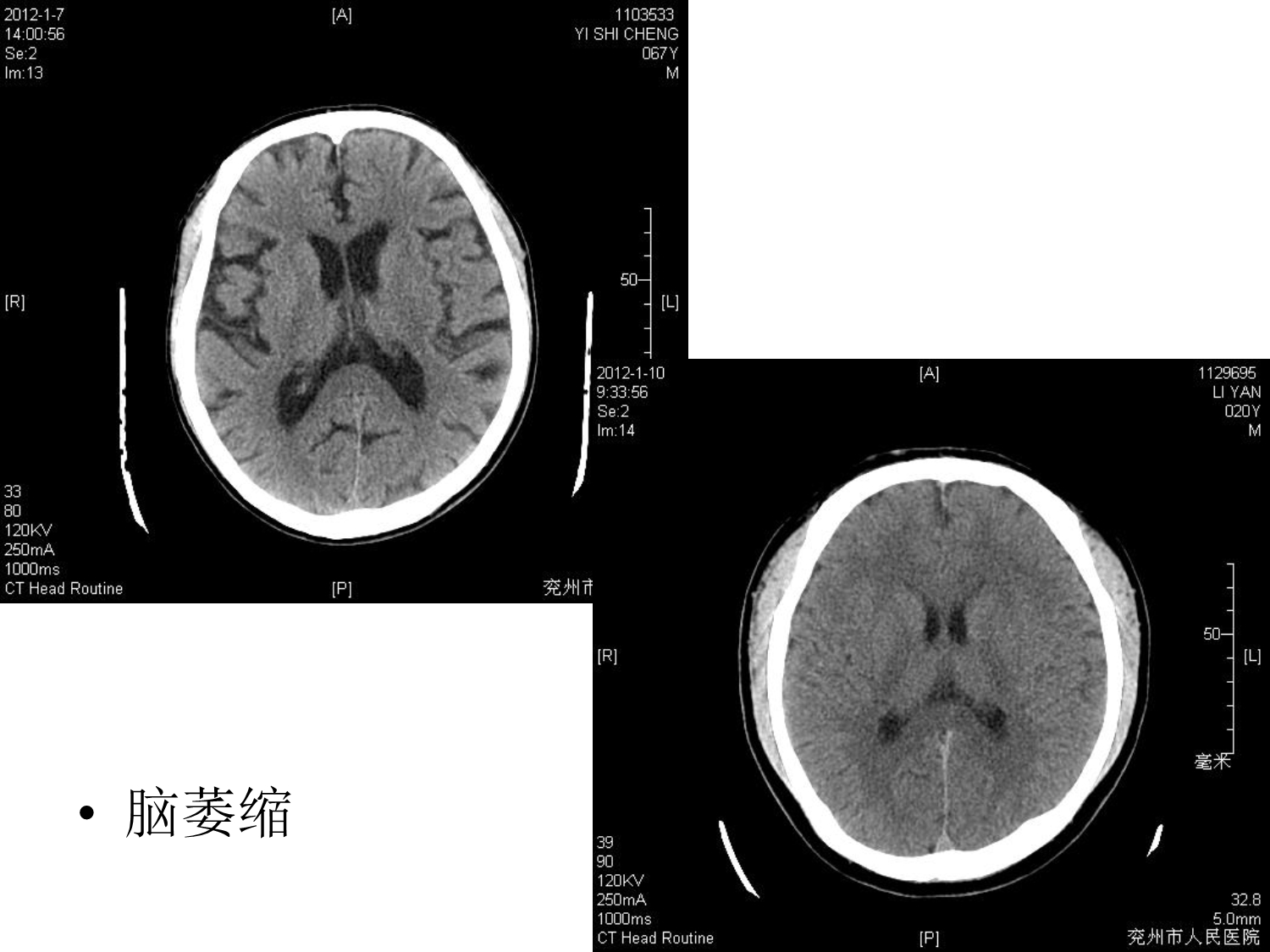 医院颅颈部MRI图片(上).ppt_第2页