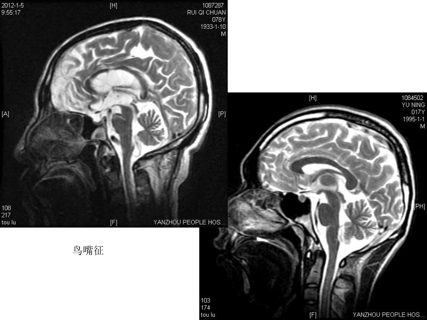 医院颅颈部MRI图片(上).ppt_第3页