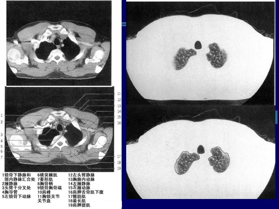 CT胸部正常解剖.ppt_第2页