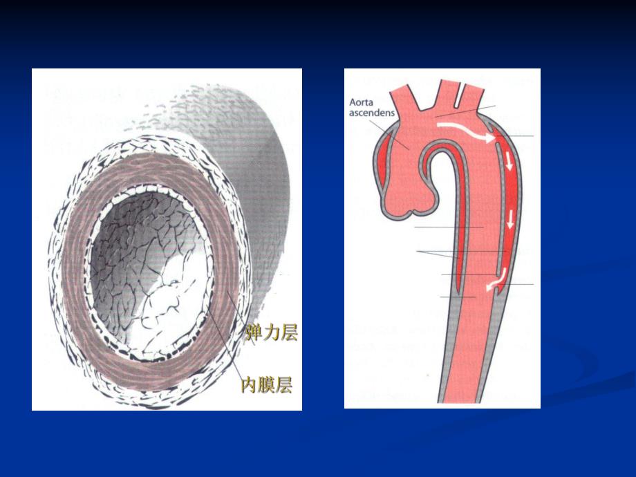 主动脉夹层动脉瘤.ppt_第3页