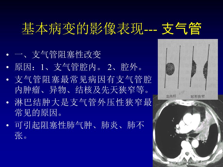 呼吸系统基本病变3.ppt_第3页