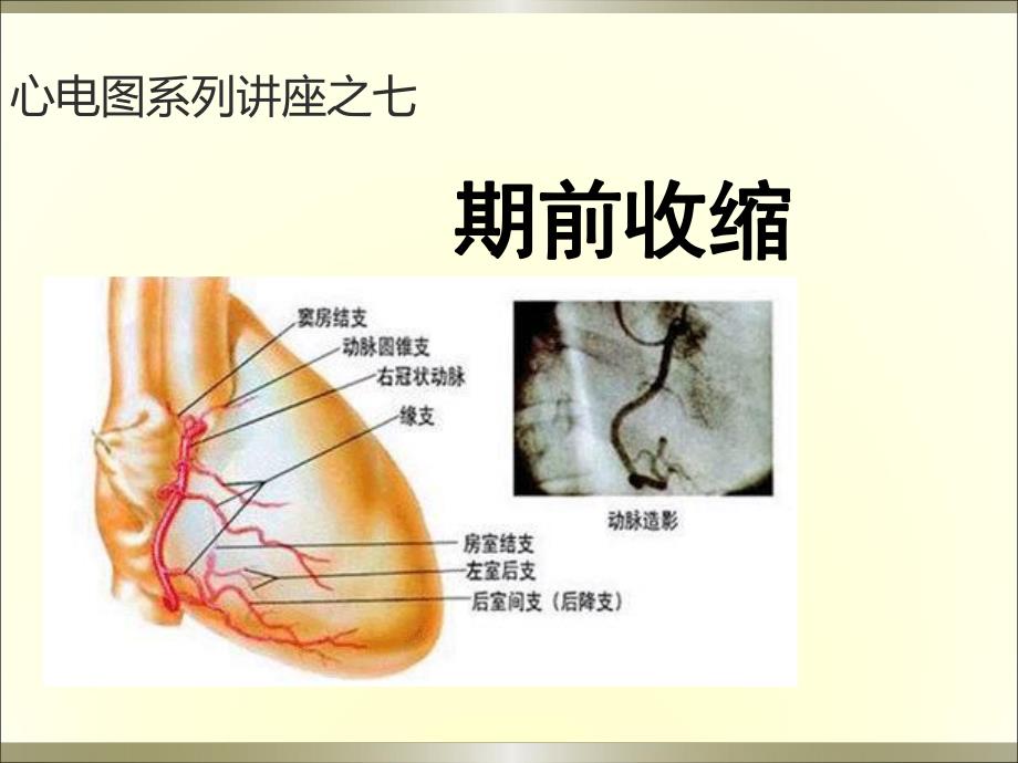 心电图系列讲座7期前收缩.ppt_第1页