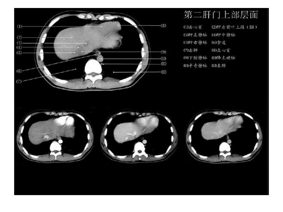 正常肝脏CT解剖.ppt_第3页