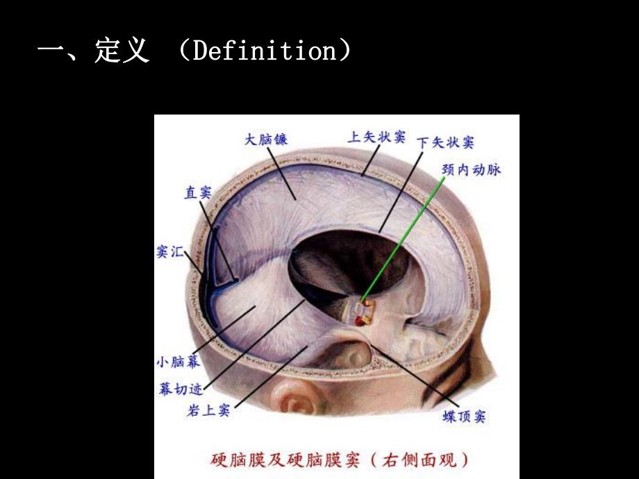 硬膜外血肿的CT诊断ppt.ppt_第3页