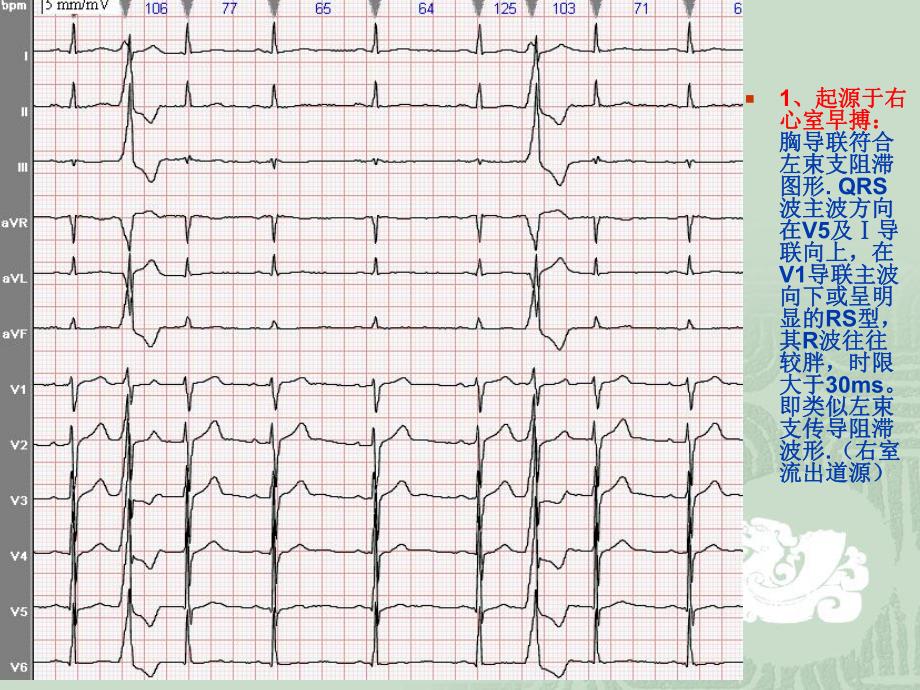 室性早搏定位诊断2.ppt_第2页