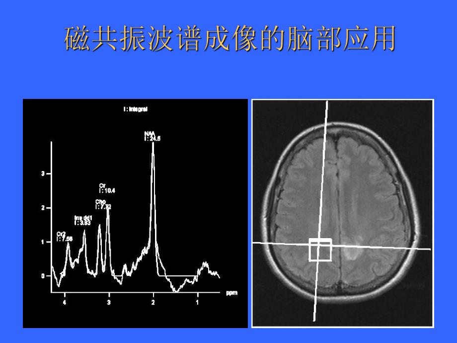 磁共振波谱成像的脑部应用.ppt_第1页