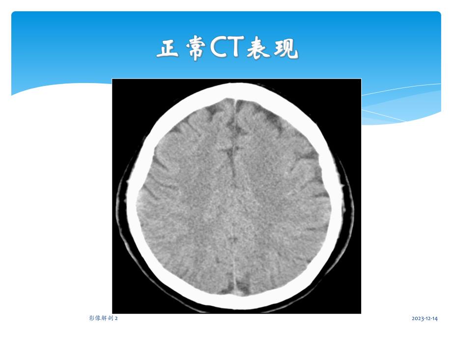 中枢神经系统CT诊断.ppt_第2页