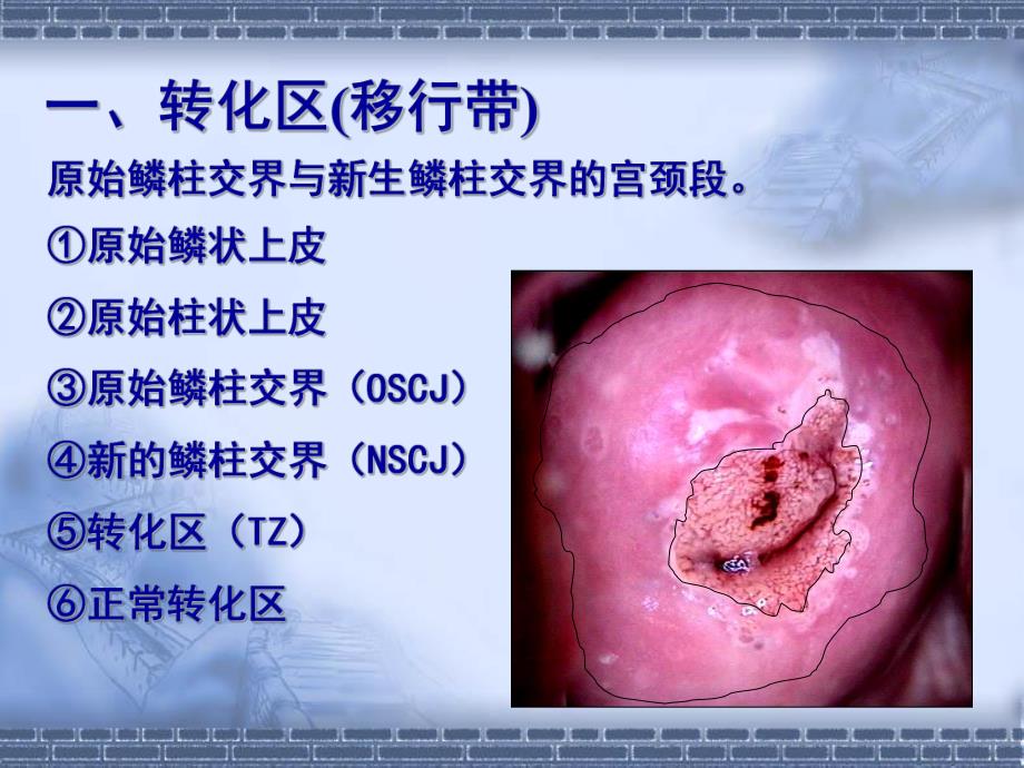 宫颈病变几个重要概念及问题思考.ppt_第3页