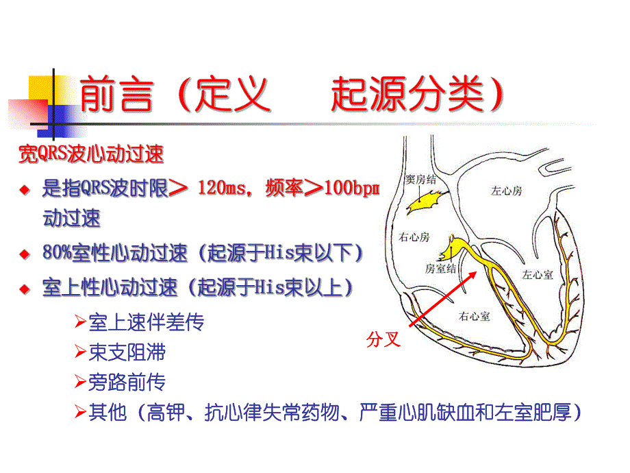 宽QRS波心动过速的鉴别诊断.ppt_第2页