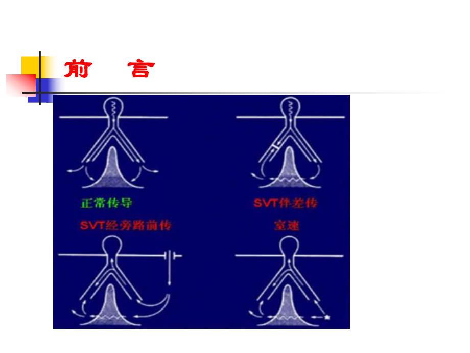 宽QRS波心动过速的鉴别诊断.ppt_第3页