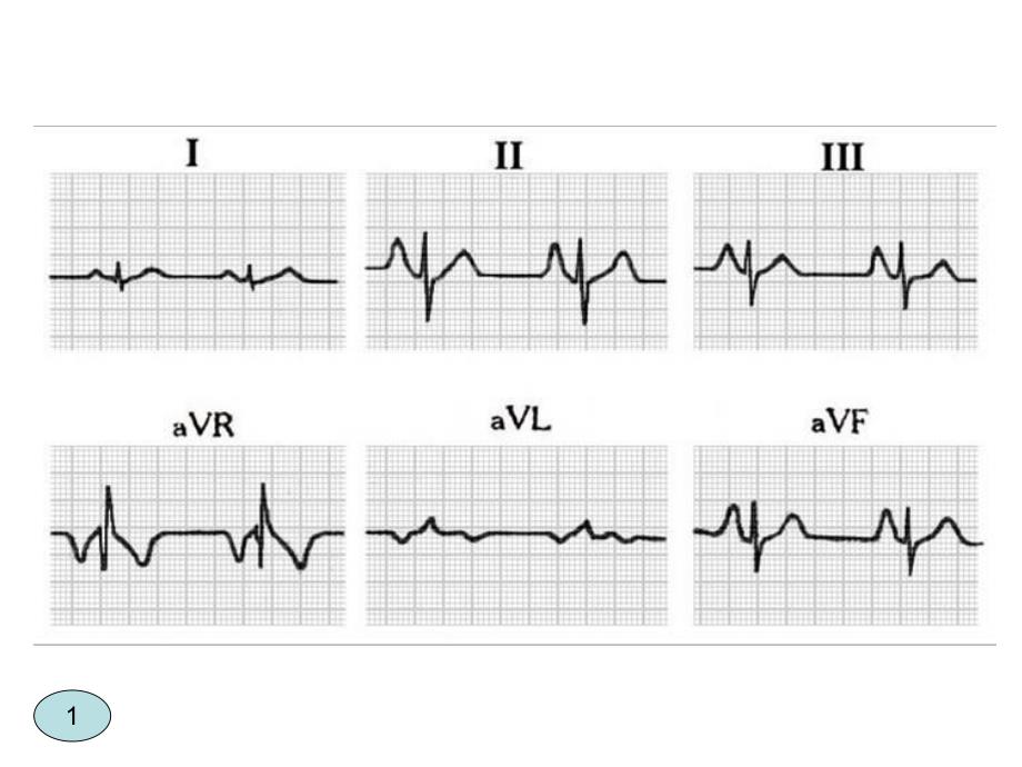 快速阅读心电图.ppt_第3页
