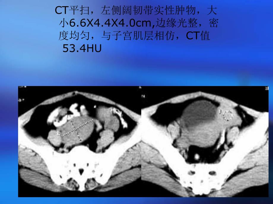 CT在女性生殖系统的应用.ppt_第3页