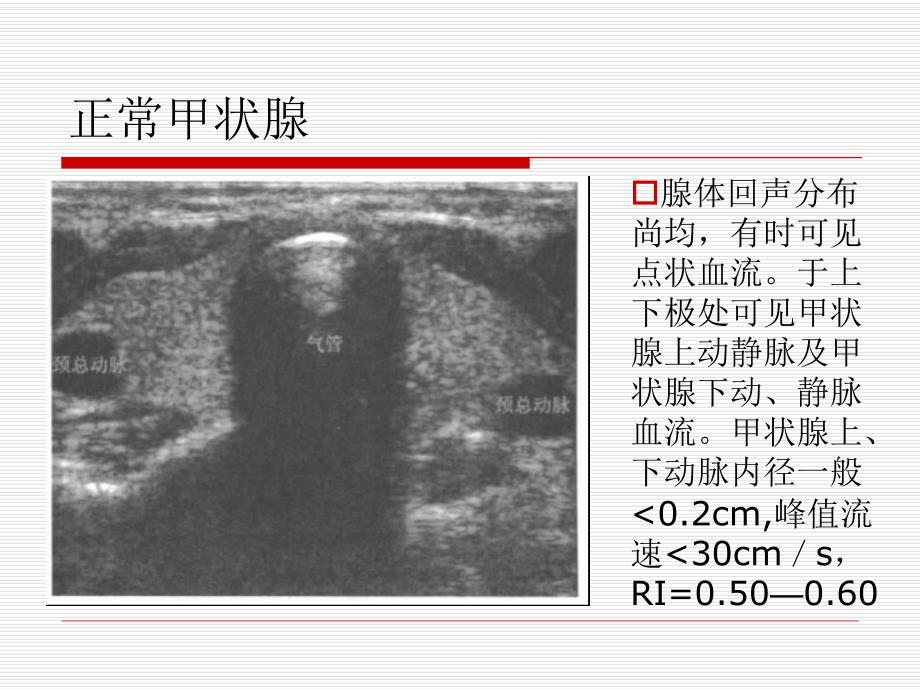 甲状腺超声诊断.ppt_第3页