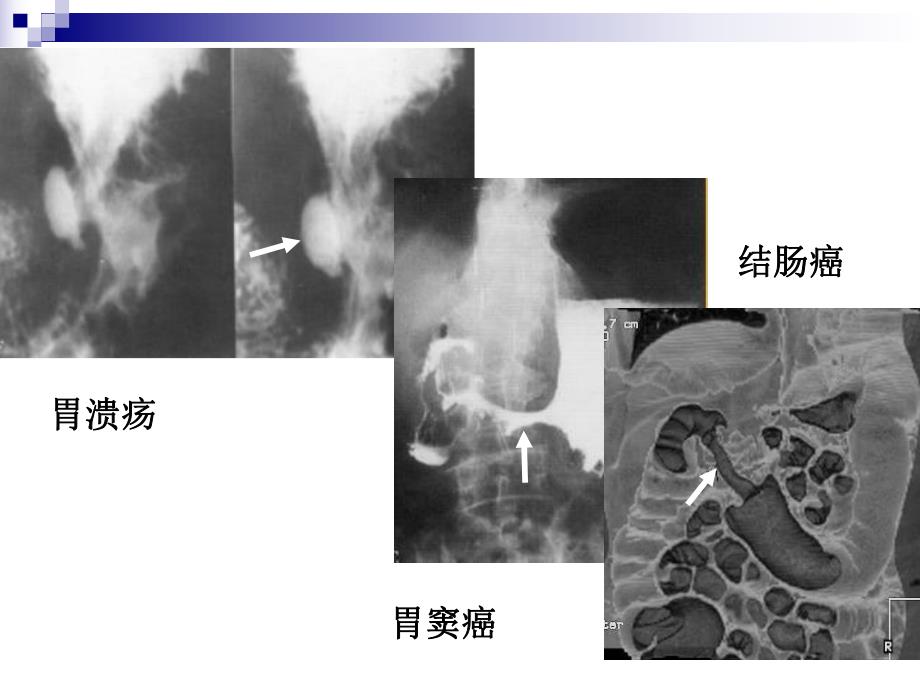 胃肠道疾病影像诊断总论ppt.ppt_第3页