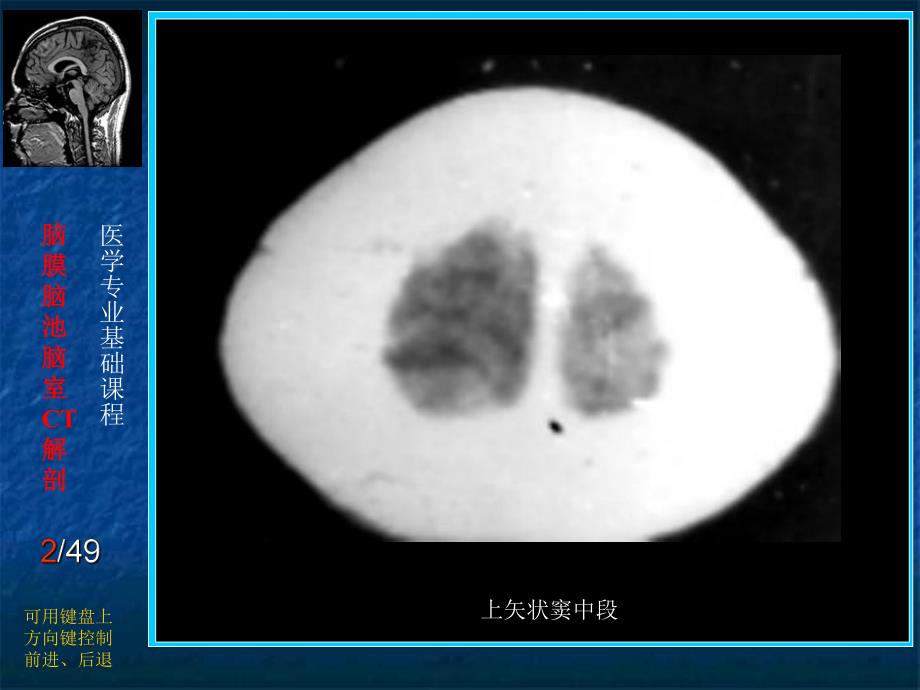 脑膜、脑池、脑室CT解剖.ppt.ppt_第2页