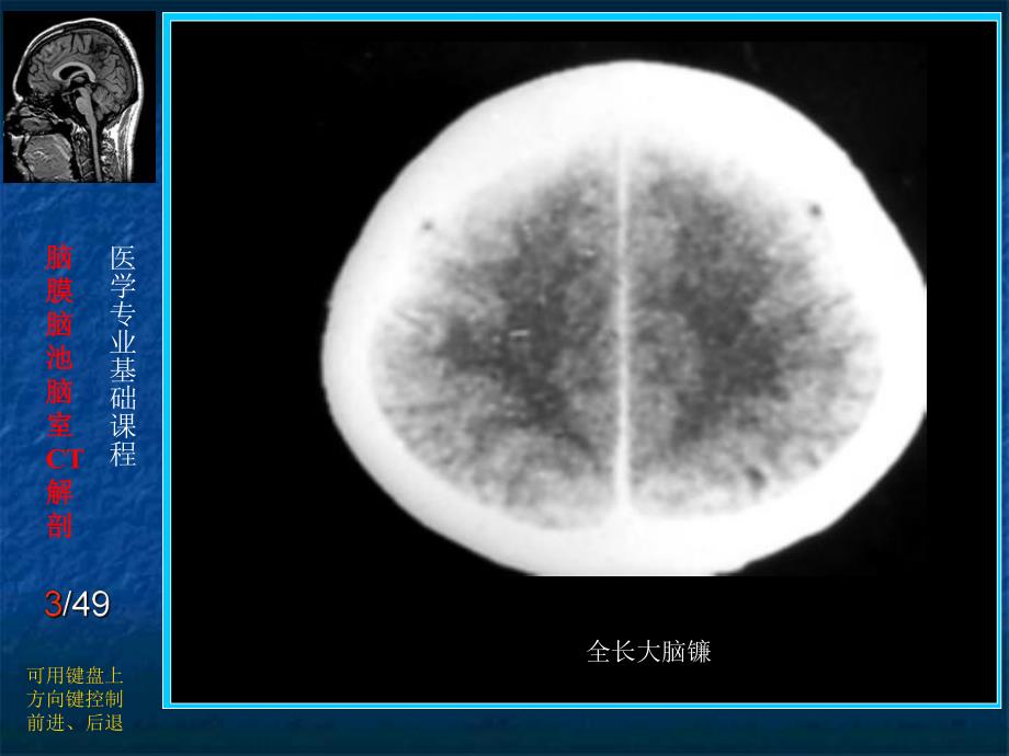 脑膜、脑池、脑室CT解剖.ppt.ppt_第3页