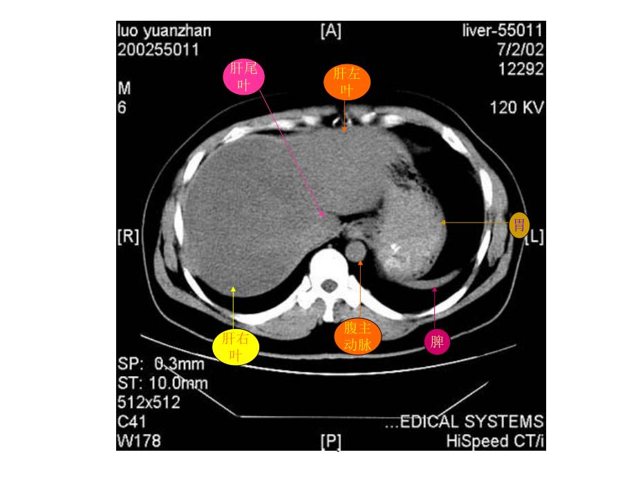 腹部CT专题培训教学PPT.ppt_第3页