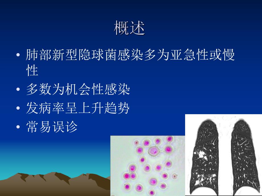 肺隐球菌病的CT诊断.ppt_第2页