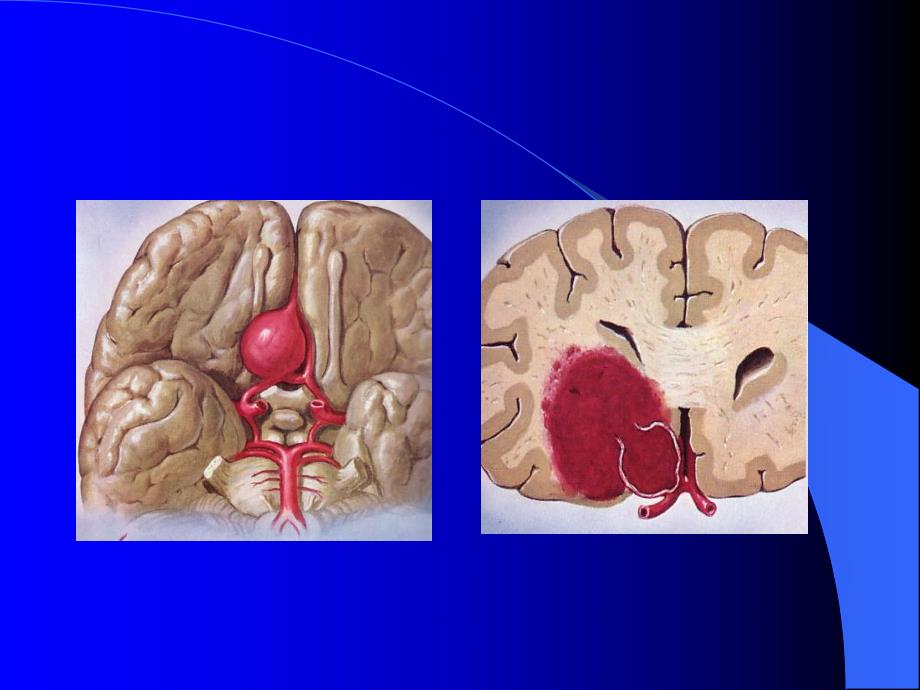 颅内动脉瘤.ppt_第2页