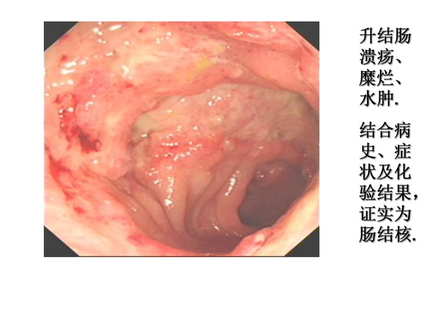 腹部结核.ppt_第3页