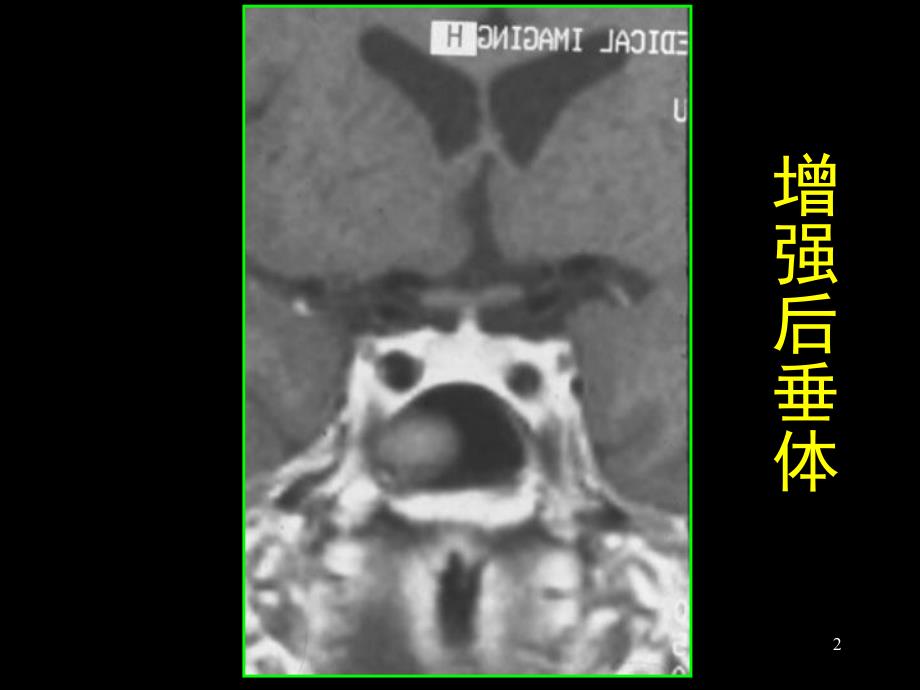 鞍区解剖及病变.ppt_第2页