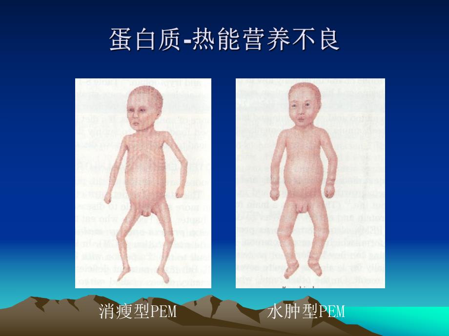 第四节营养缺乏病的预防.ppt_第3页