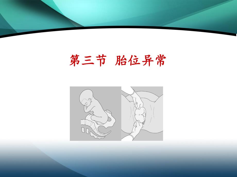 八制胎位异常.ppt_第2页