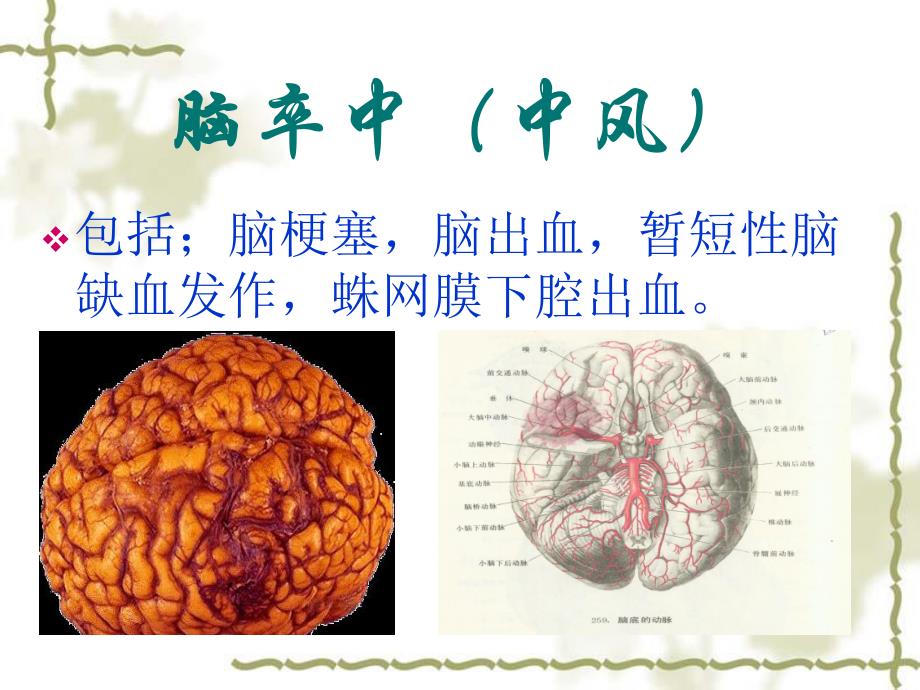 脑卒中一级预防护.ppt_第2页