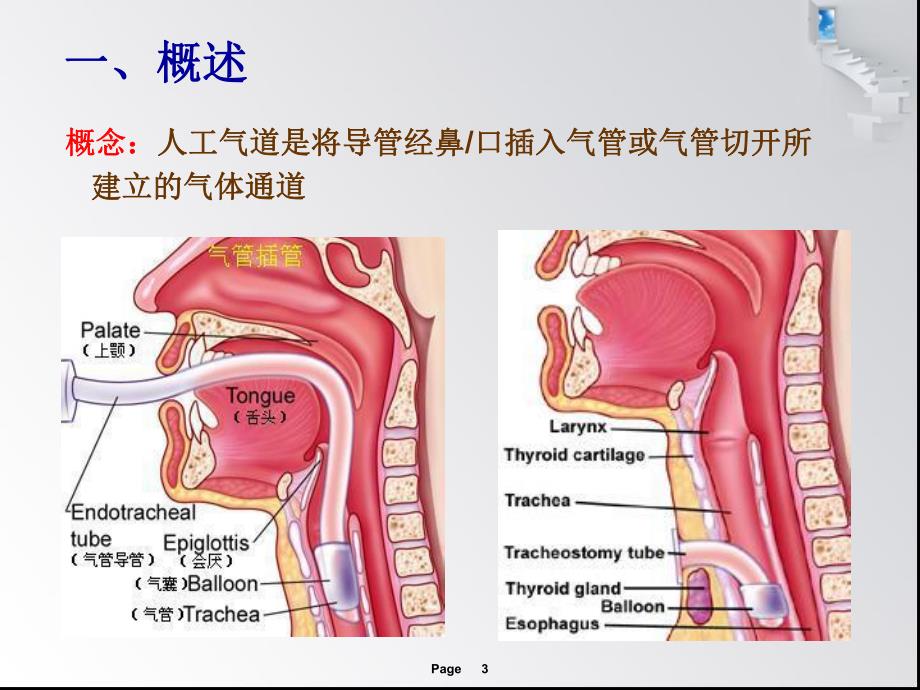 人工气道管理新进展.ppt_第3页