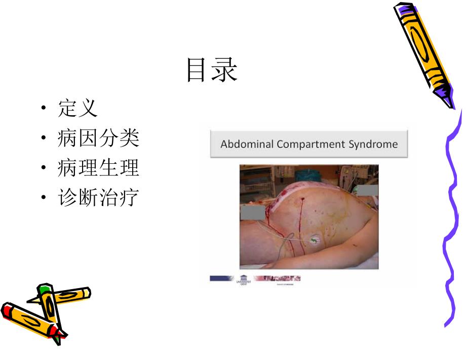 腹腔间隙综合征.ppt_第2页