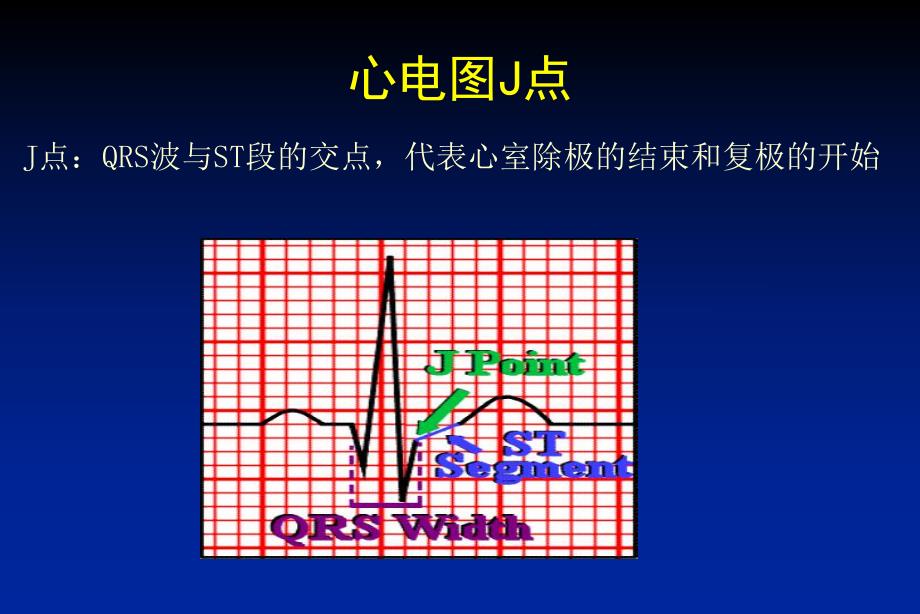 早复极与J波综合征(PPT46).ppt_第2页