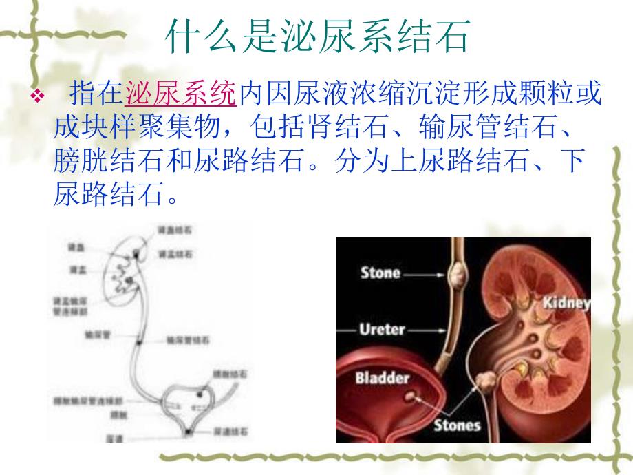 结石病人饮食指导图文.ppt_第3页