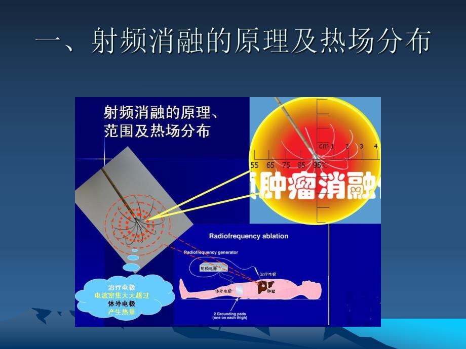 射频消融术的重大技术突破.ppt_第2页