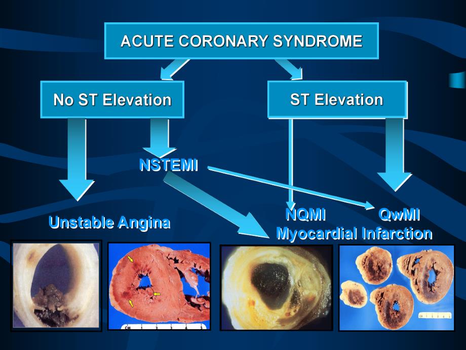 急性冠脉综合征.ppt_第3页