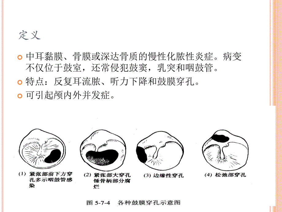 慢性化脓性中耳炎医学幻灯片.ppt_第2页