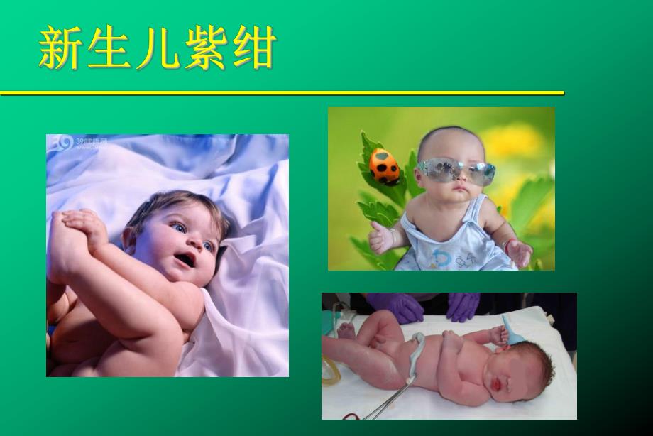 新生儿青紫.ppt.ppt_第1页