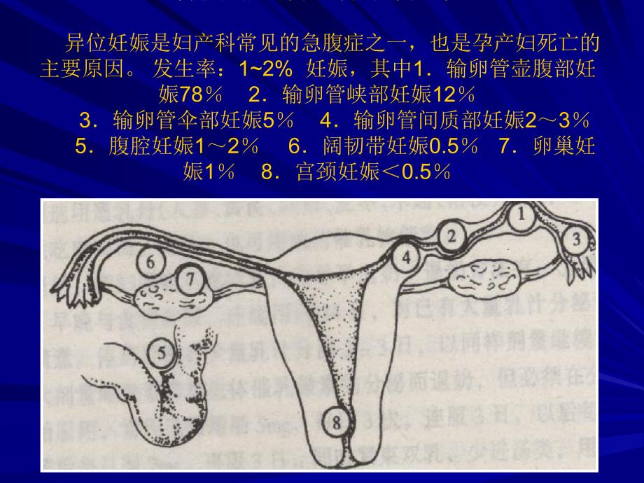 异位妊娠的诊治.ppt_第3页