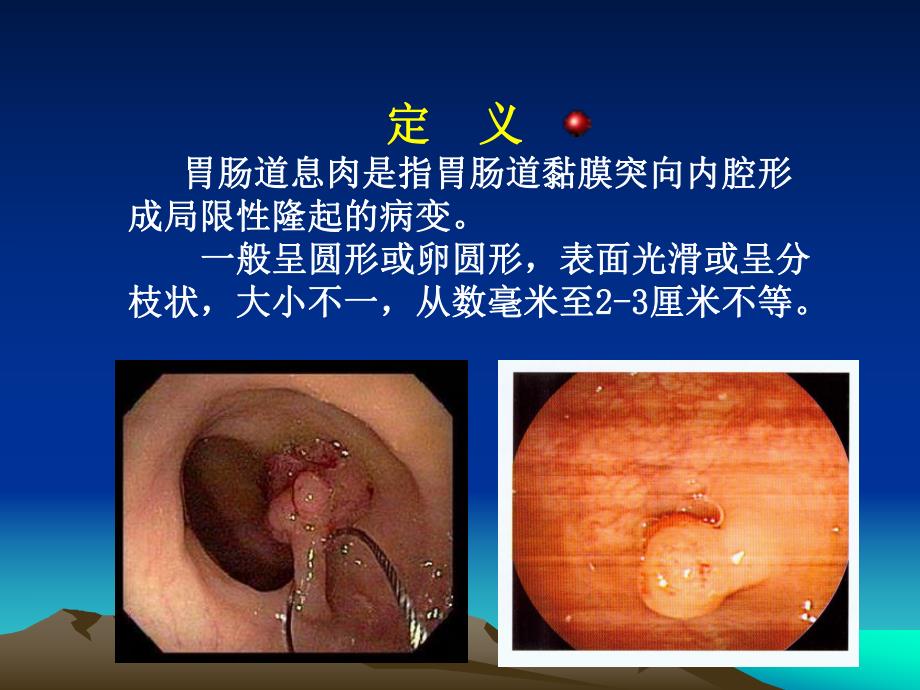 胃肠道息肉内镜下电凝切除术.ppt_第2页