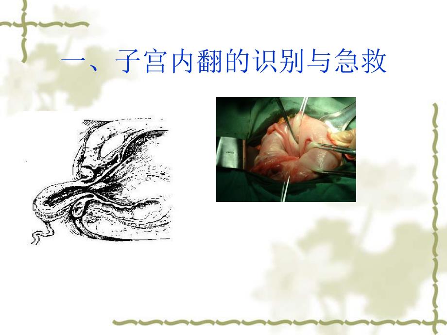 分娩期急症的识别ppt.ppt_第3页