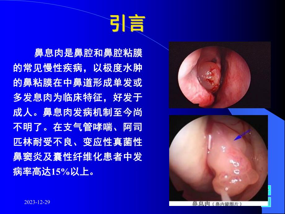 鼻息肉幻灯片.ppt_第2页