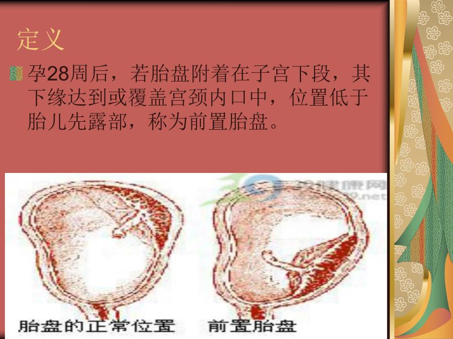 前置胎盘2.ppt_第3页